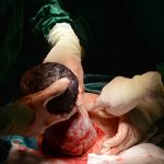 C-Section (Cesarean Section): What You Must Know