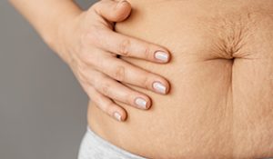 Nurturing Your Skin Post-Pregnancy: Dealing with Stretch Marks