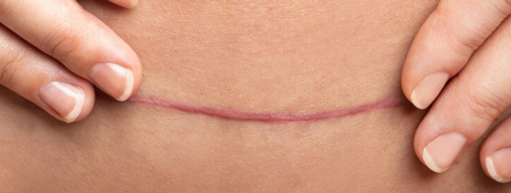 c section stitches